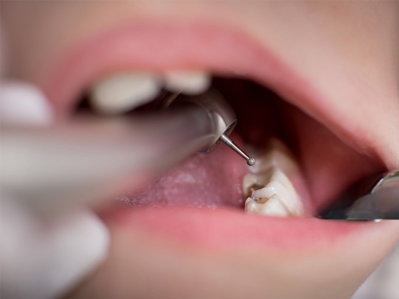 Tartar on Teeth1