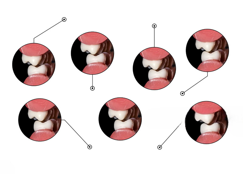 Tooth Retainer Brace Orthodontics1