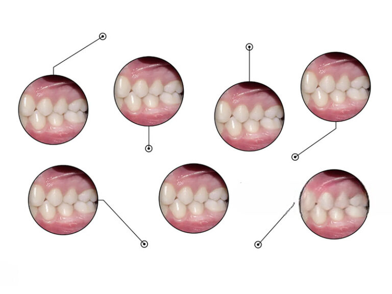 Tooth Retainer Brace Orthodontics