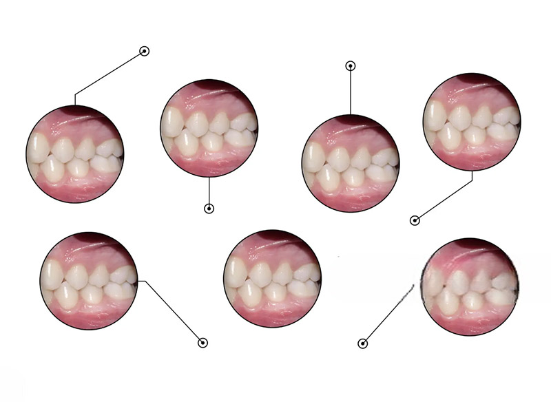 Tooth Retainer Brace Orthodontics