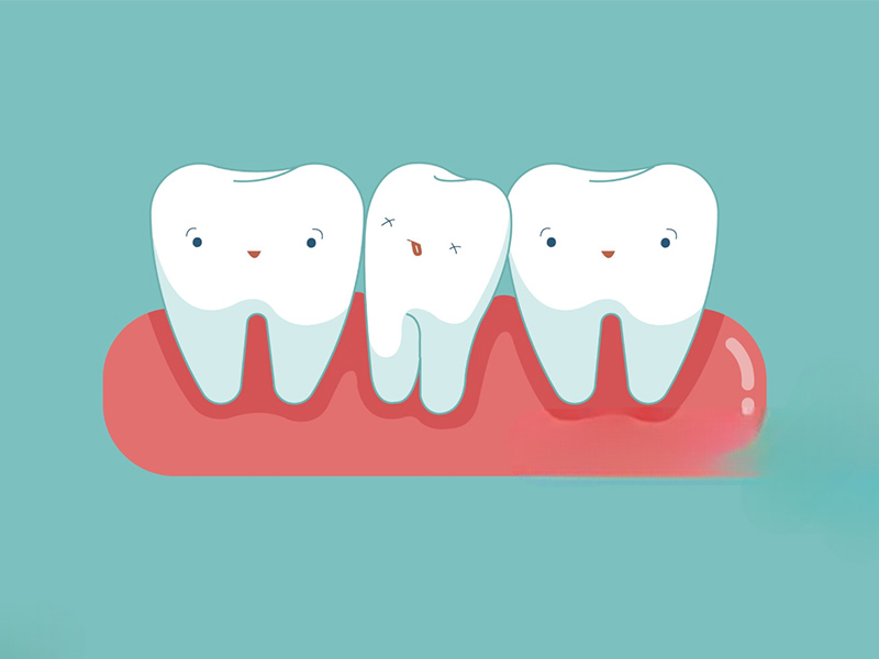 Understanding Hypodontia