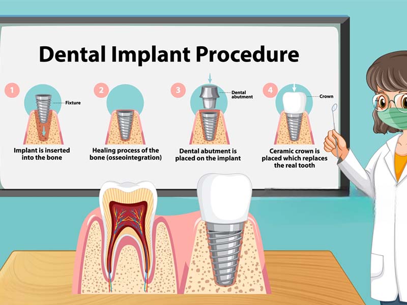 Understanding the Dental Implant Process Timeline