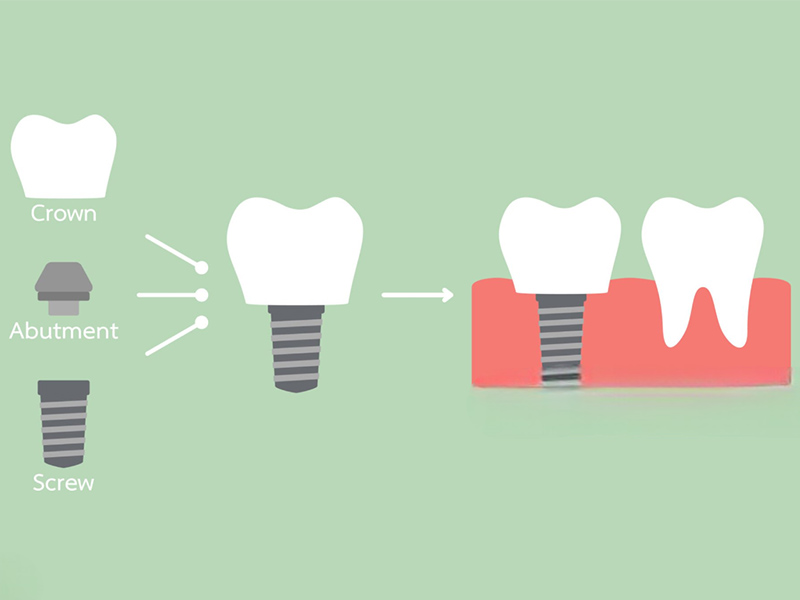 Understanding the Dental Implant Process Timeline1 1