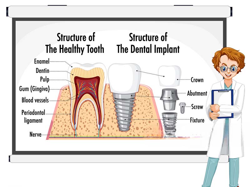 Understanding the Dental Implant Process Timeline2 1