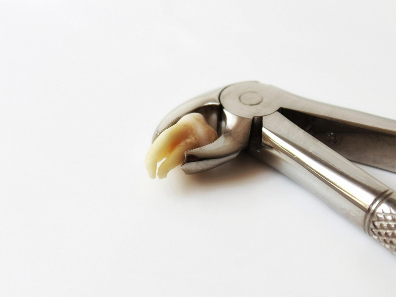 Wisdom Teeth Removal