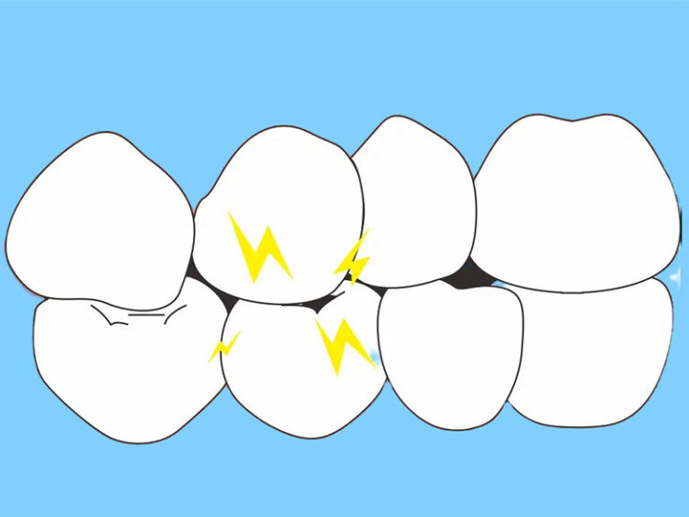 bruxism