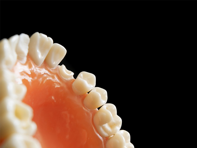 dental implants