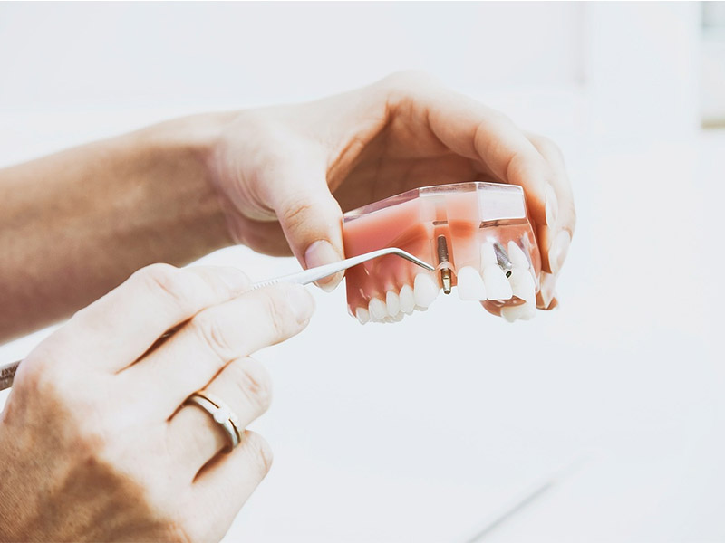dental implants3