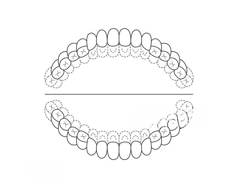 Orthodontic sports