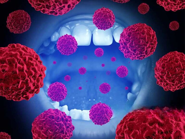 oral cancer