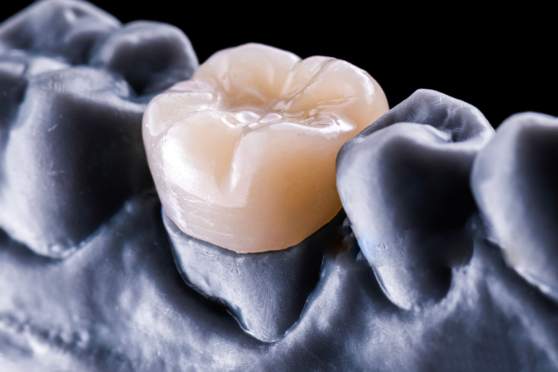 Best Temporary Crown Material (1)