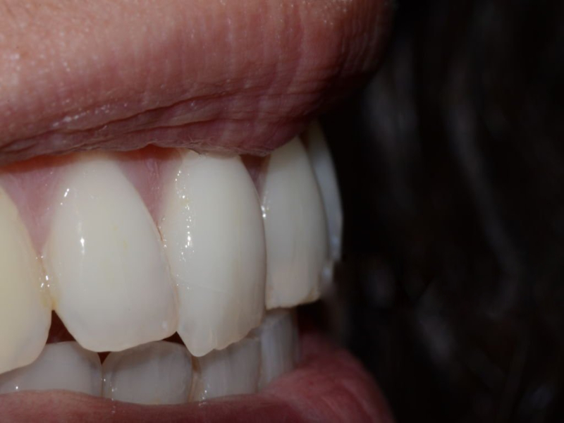 Bonding is not as strong as ceramic veneers (1)