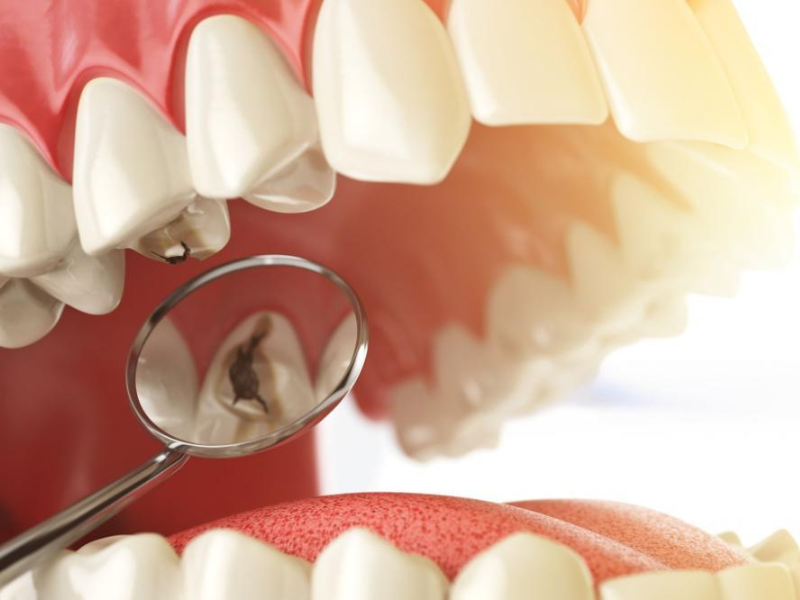 Cavity Fillings Hurt (2)
