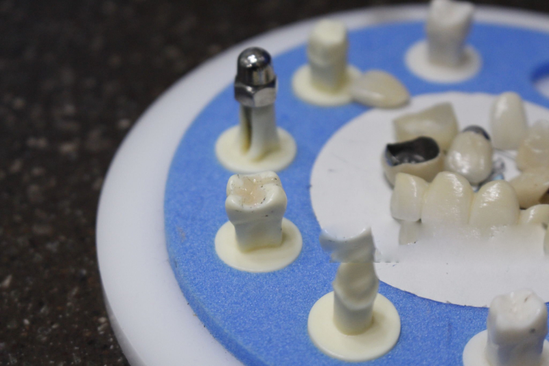 Cement-Retained dental Crowns (1)