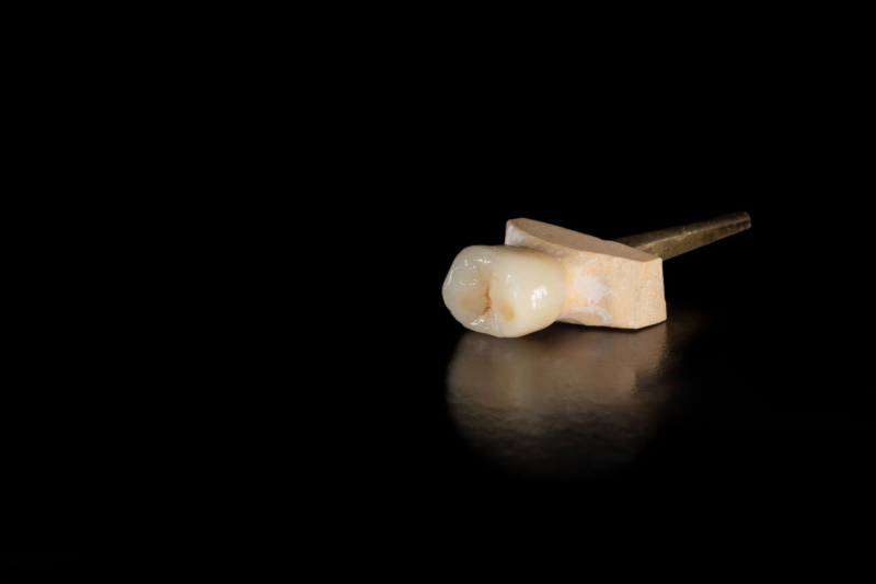 Chipping and Breaking Zirconia Crown (1)