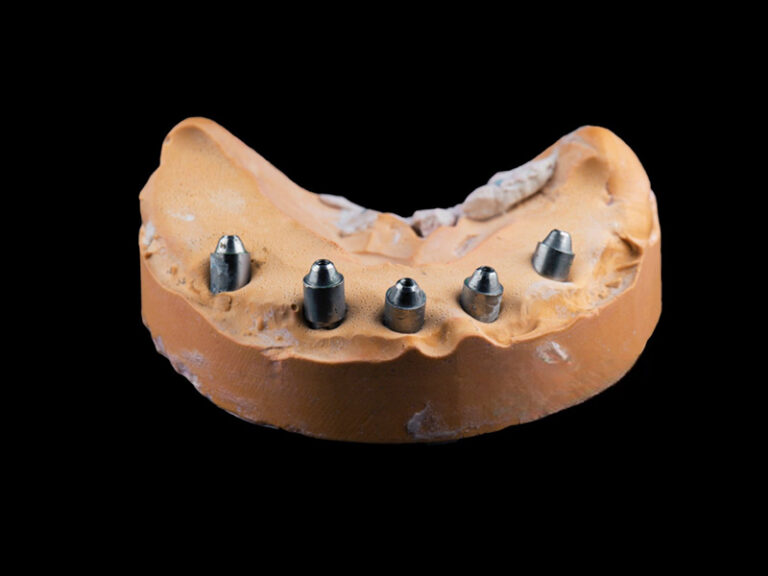 Custom Abutments
