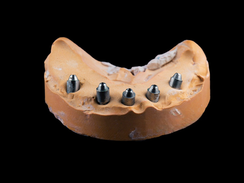 Custom Abutments