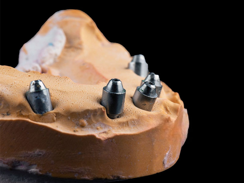 Custom Abutments2