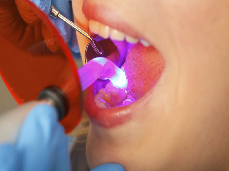 Dental Bonding Cost, Procedure & Benefits Guide (1)