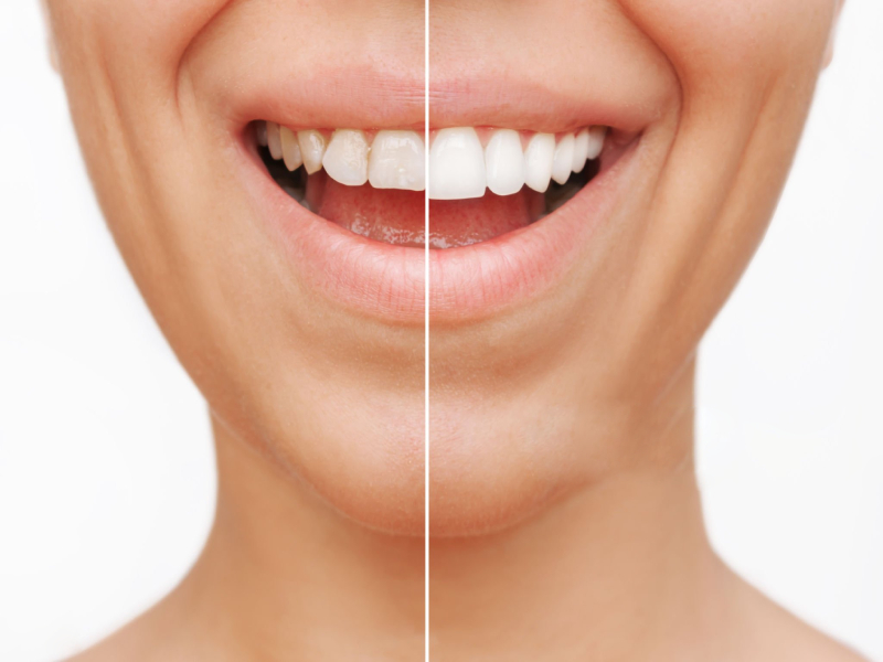 Dental Veneers What to Expect Before, During, and After (1)