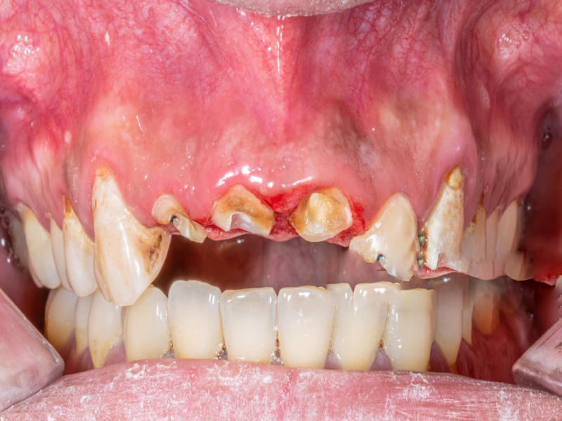 Enamel Erosion (1)