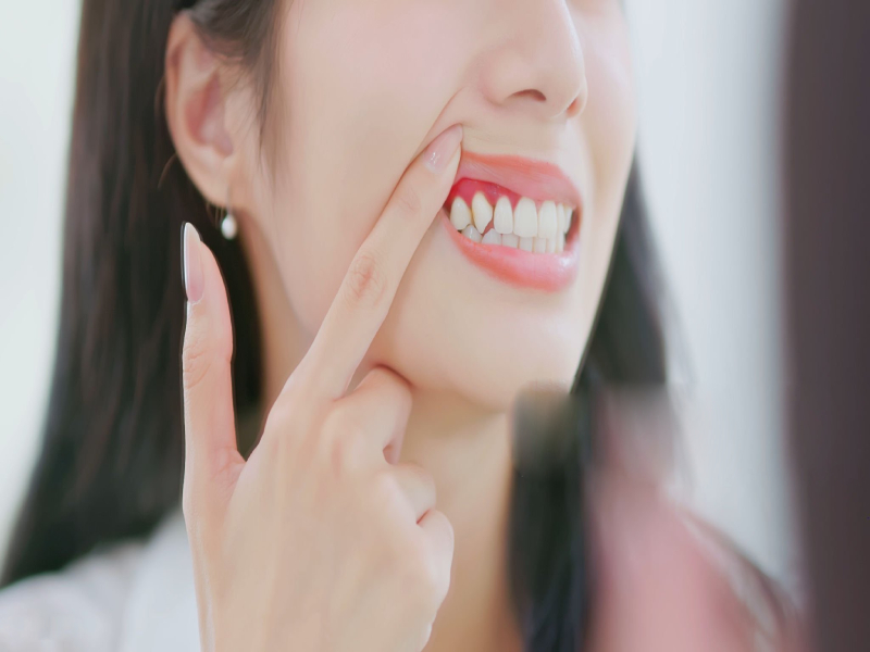 Gum Disease (1)