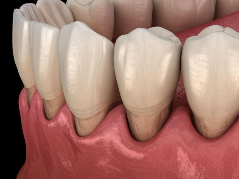 Gum Recession Treatment (1)