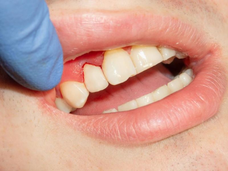 Gum Recession Treatment (2)