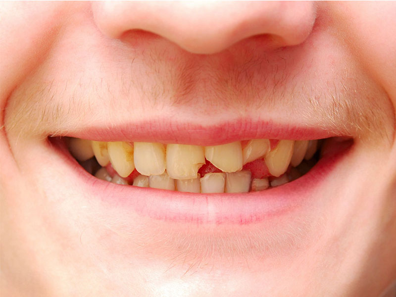How to Detect and Deal with a Cracked Tooth