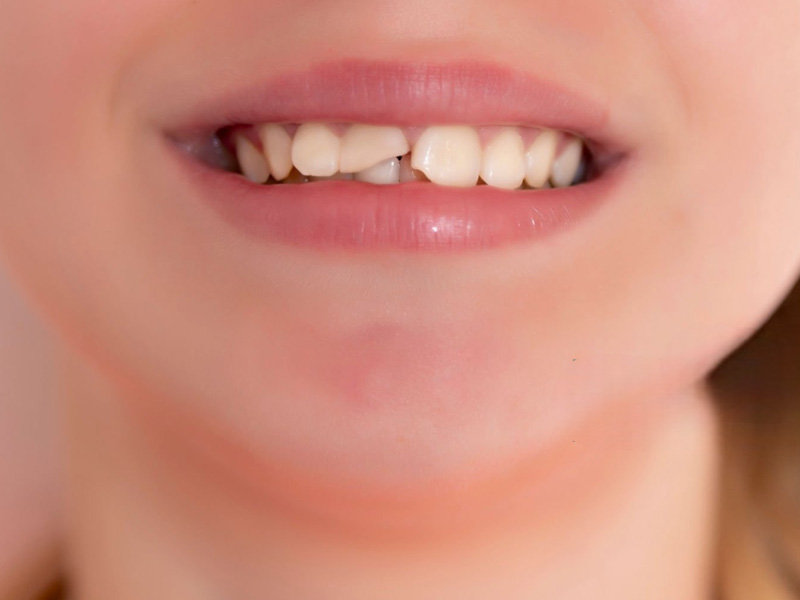 How to Detect and Deal with a Cracked Tooth2