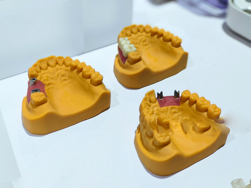 Loose Implant Crowns in Patients (1)