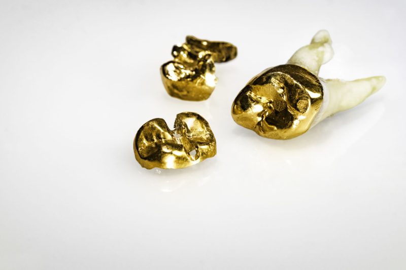 PFM crown alloys longevity, high-noble vs non-precious metal (1)