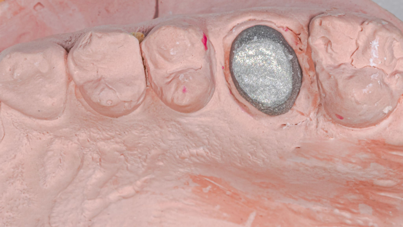 PFM metal oxidation process, porcelain-metal bond failure (1)