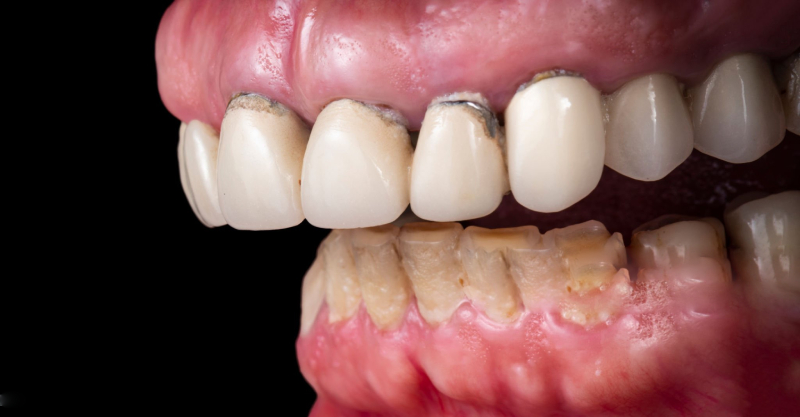 PFM teeth Problems (1)