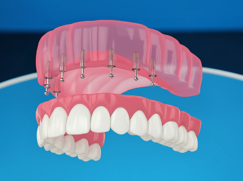 Snap-In Dentures (1)