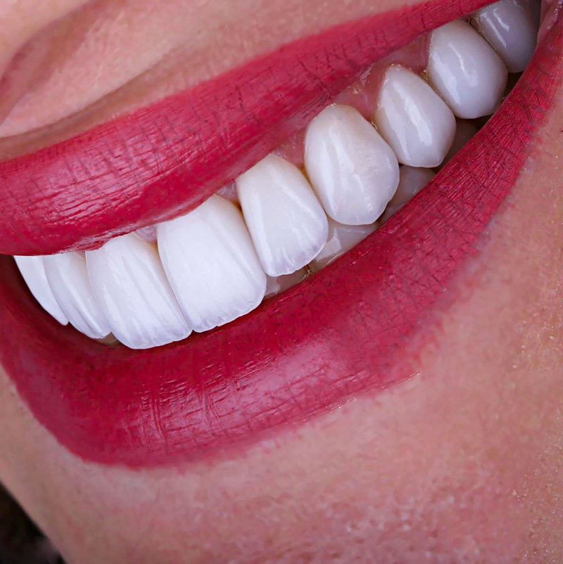 Taking Care of Your e.Max Teeth (1)
