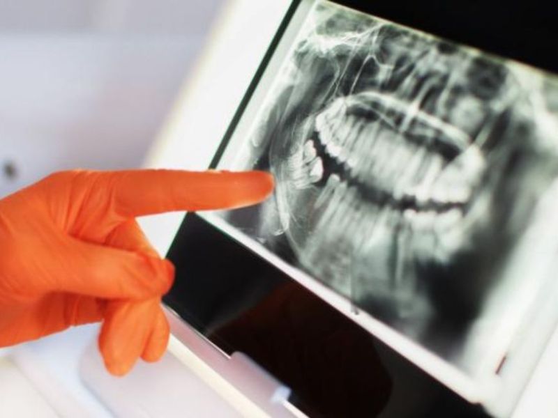 Teeth X-Rays for Children (2)