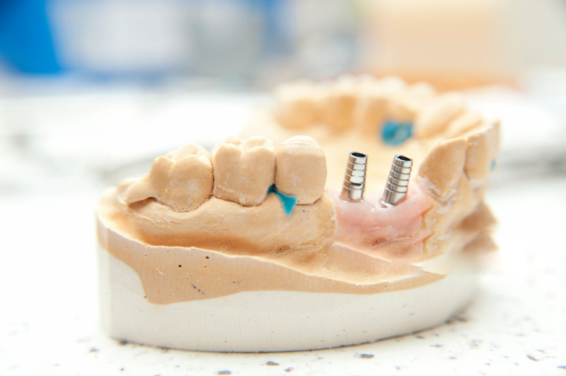 Titanium Alloys dental implant (1)