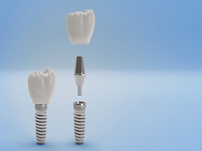 Tooth Replacement Options After Extraction implant teeth (1)