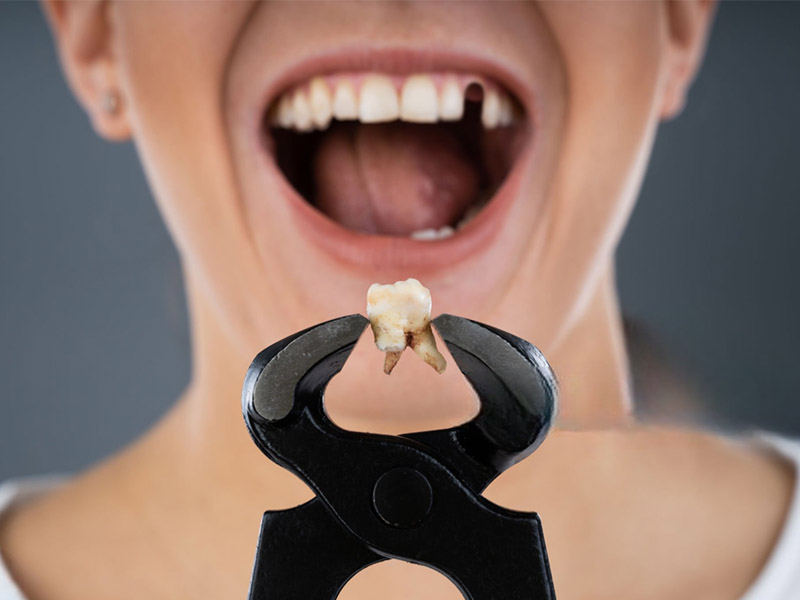 What to Expect with a Tooth Extraction