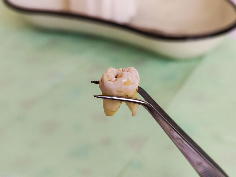 What to Expect with a Tooth