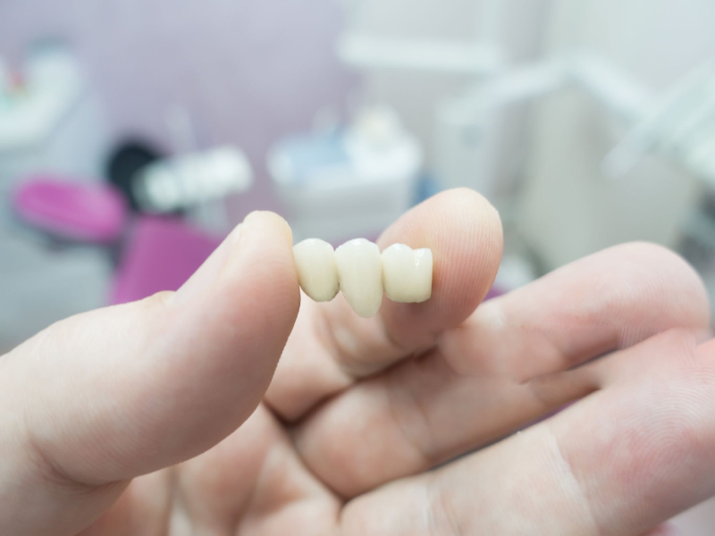 dental bridge after extraction (1)