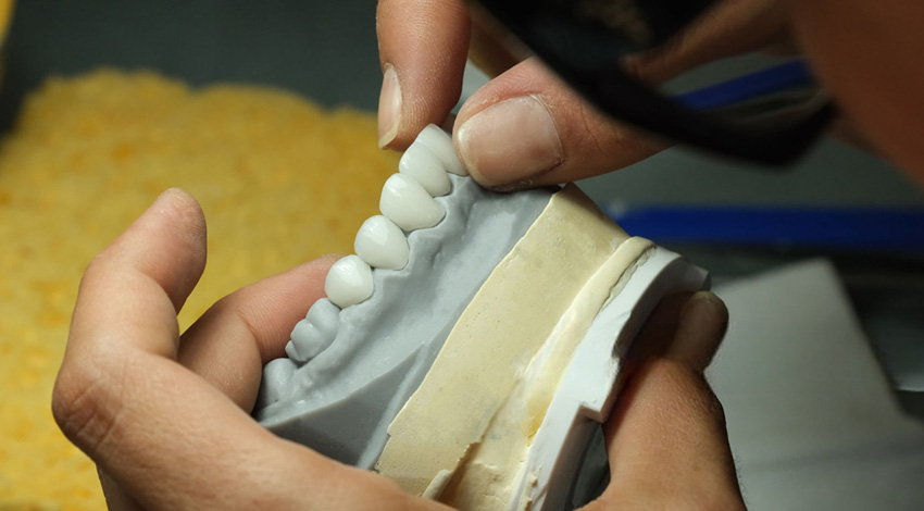 dental crown
