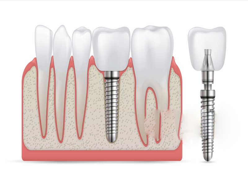 dental implants for one tooth (1)