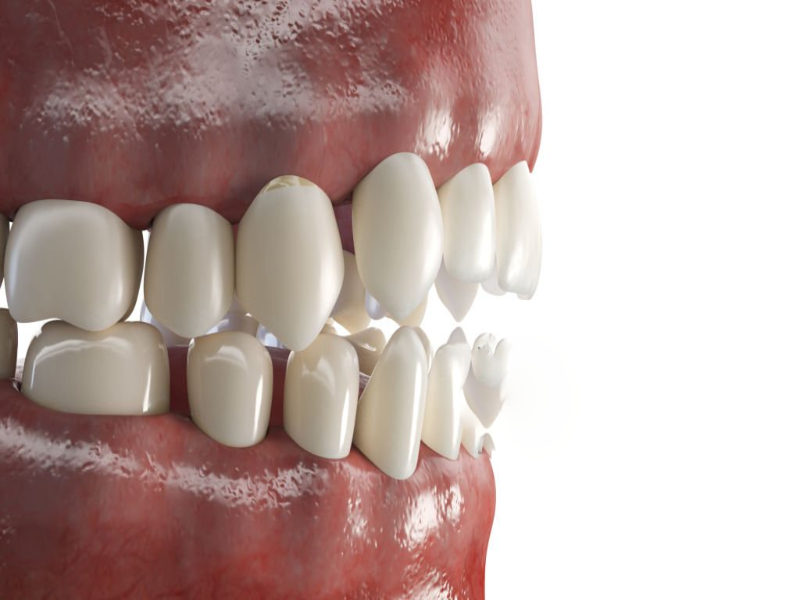 thinner dental veneer (1)