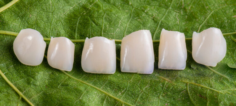 ultra-thin veneers (1)