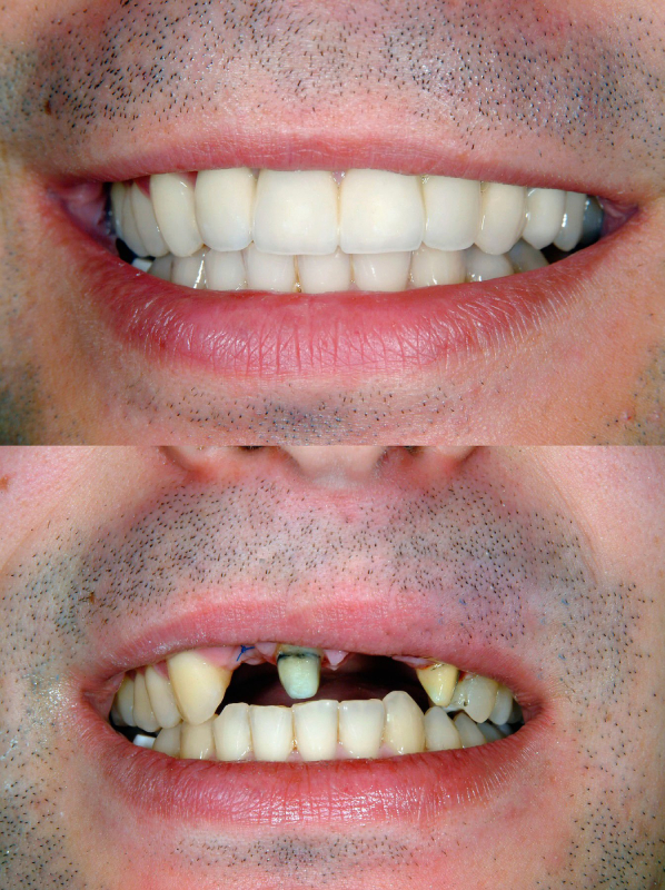 zirconia Front Tooth fixed (1)