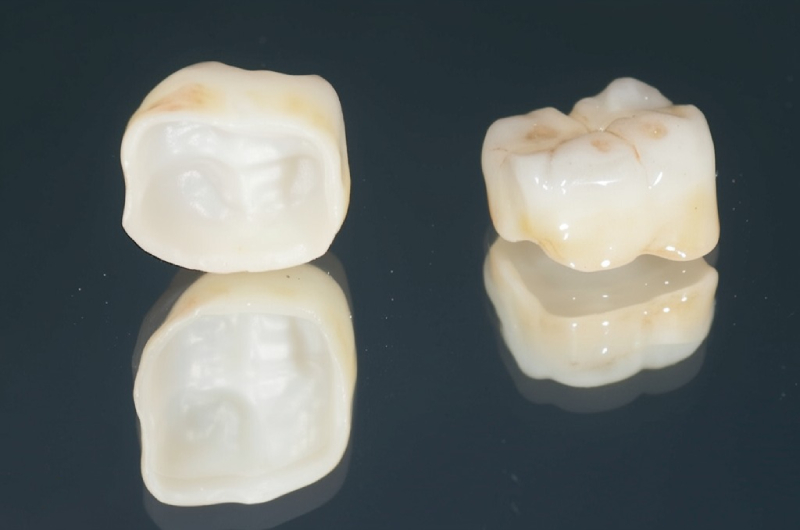 zirconia crowns edge design (1)