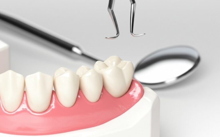 Ceramic dental crown placement on prepared tooth model