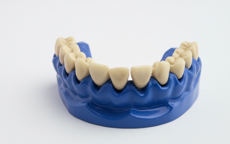 Dental implant compared to Maryland bridge